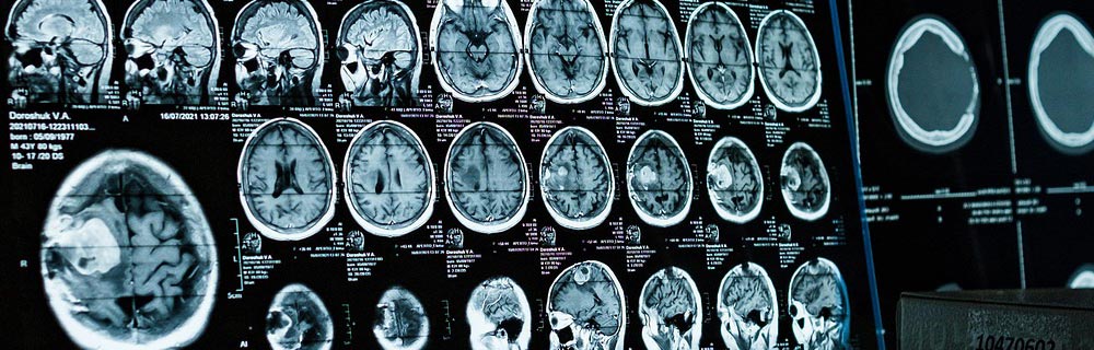 head-brain-injury head brain injury claims